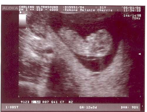 Ultrasound 11 weeks